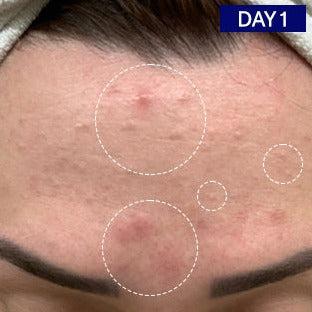 Odacite-Salicylic + Hyaluronic Acid Clarifying Serum-