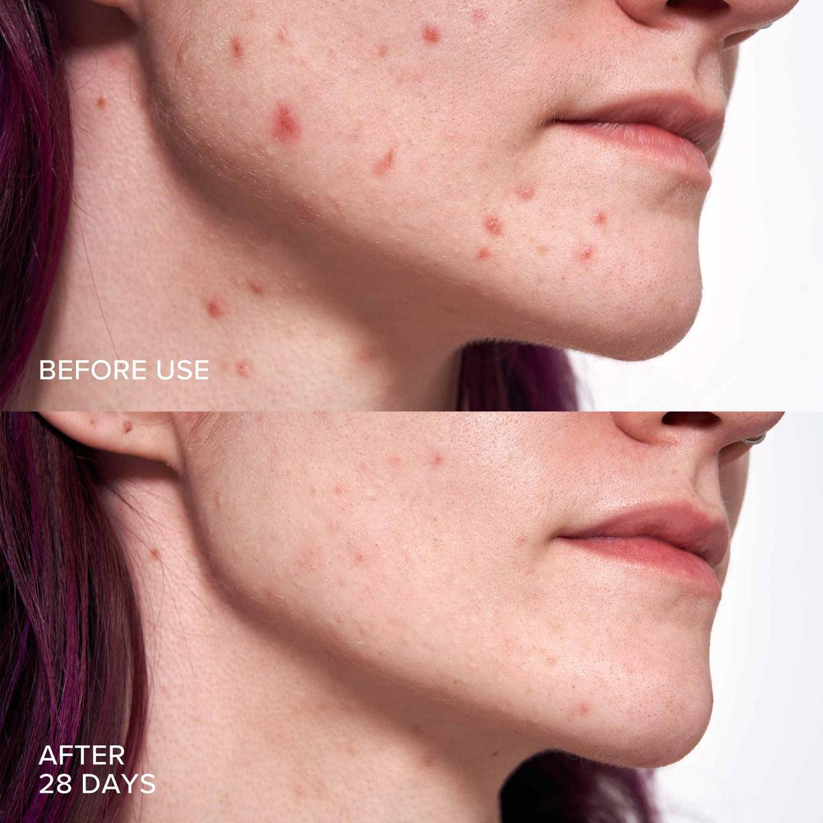 Alpyn Beauty-Pore Perfecting Liquid with 2% BHA + Borage-